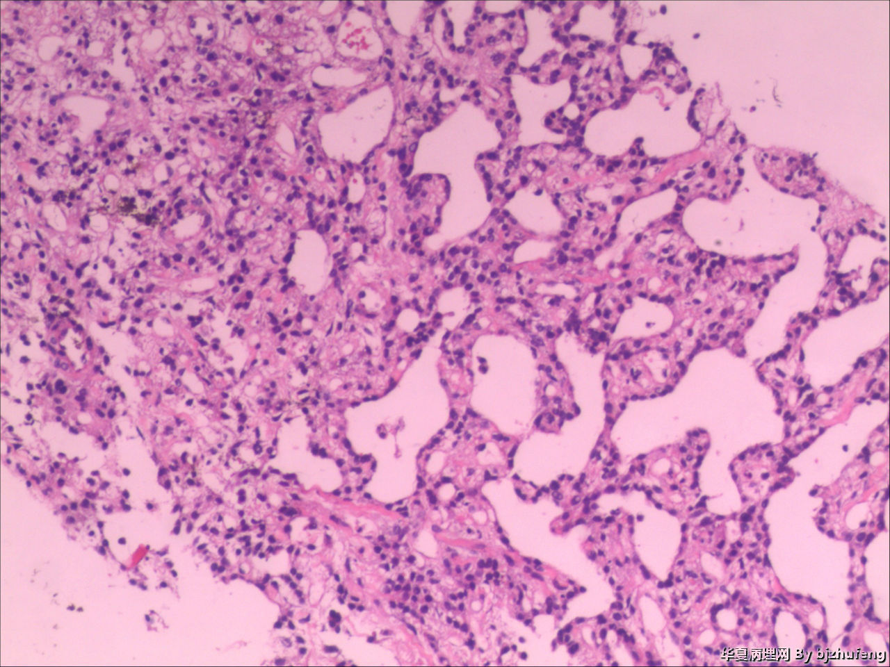 谷丙转氨酶高多少可以判定为肝癌,谷丙转氨酶偏高多少才是肝癌