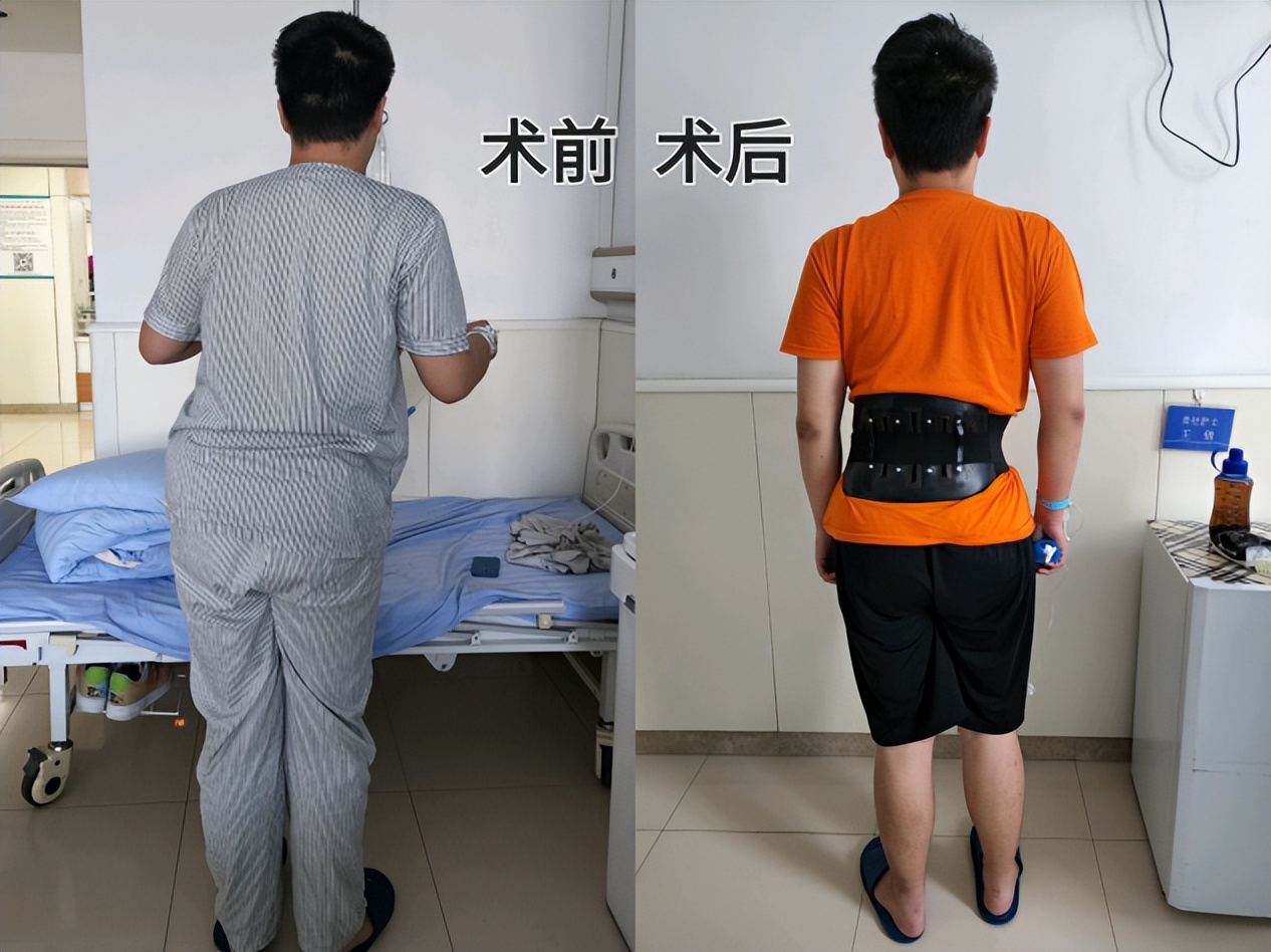 小伙“S”型身材原是腰间盘突出哈医大一院群力骨科团队脊柱上微创摘“核”解除病痛