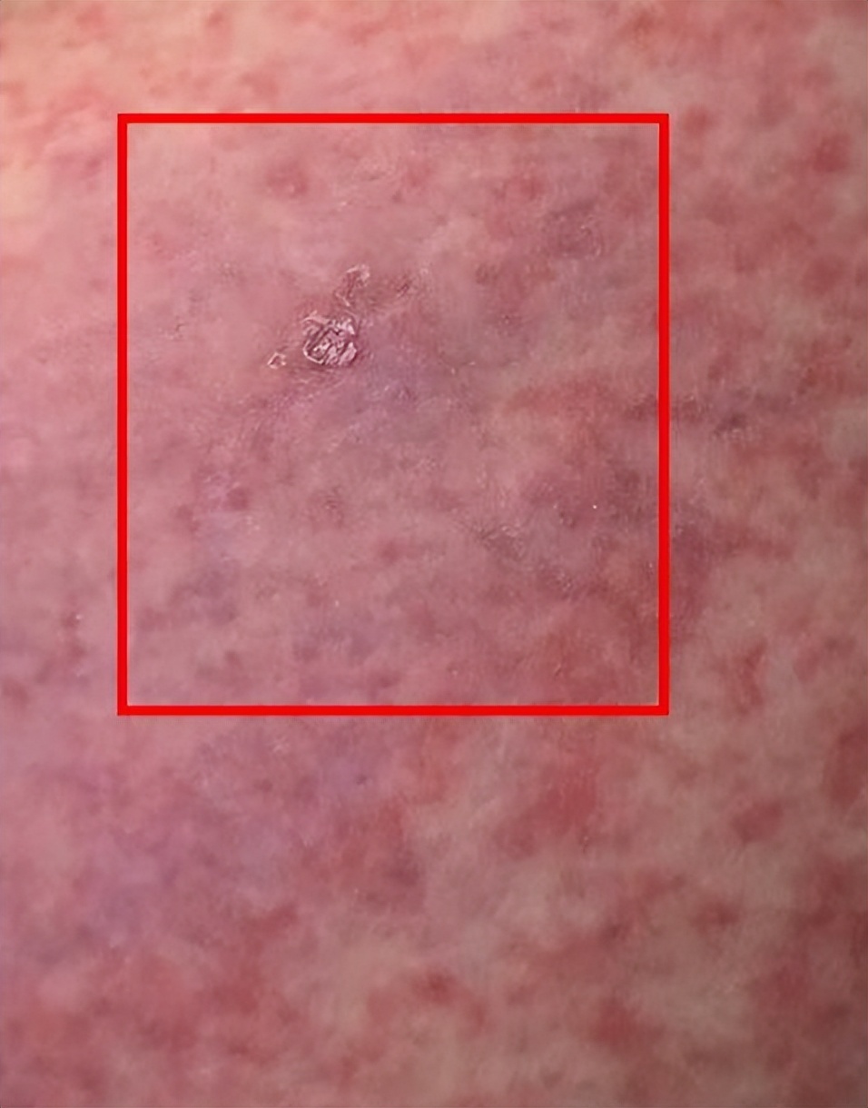 杭州女子养仓鼠脸烂成火,杭州一女子养仓鼠脸竟烂成火龙果