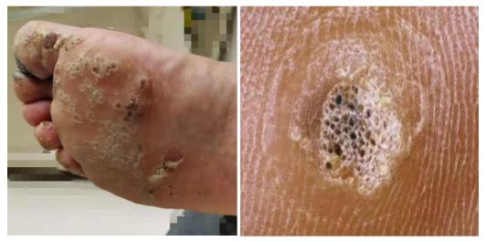 鸡眼瘊子和跖疣的区别,鸡眼跖疣傻傻分不清楚