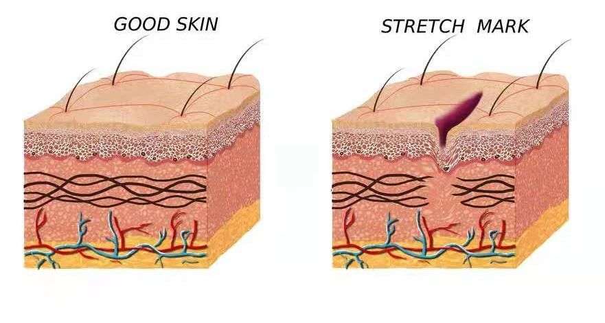 肥胖纹目前最好的去除办法,淡化肥胖纹修复肥胖纹