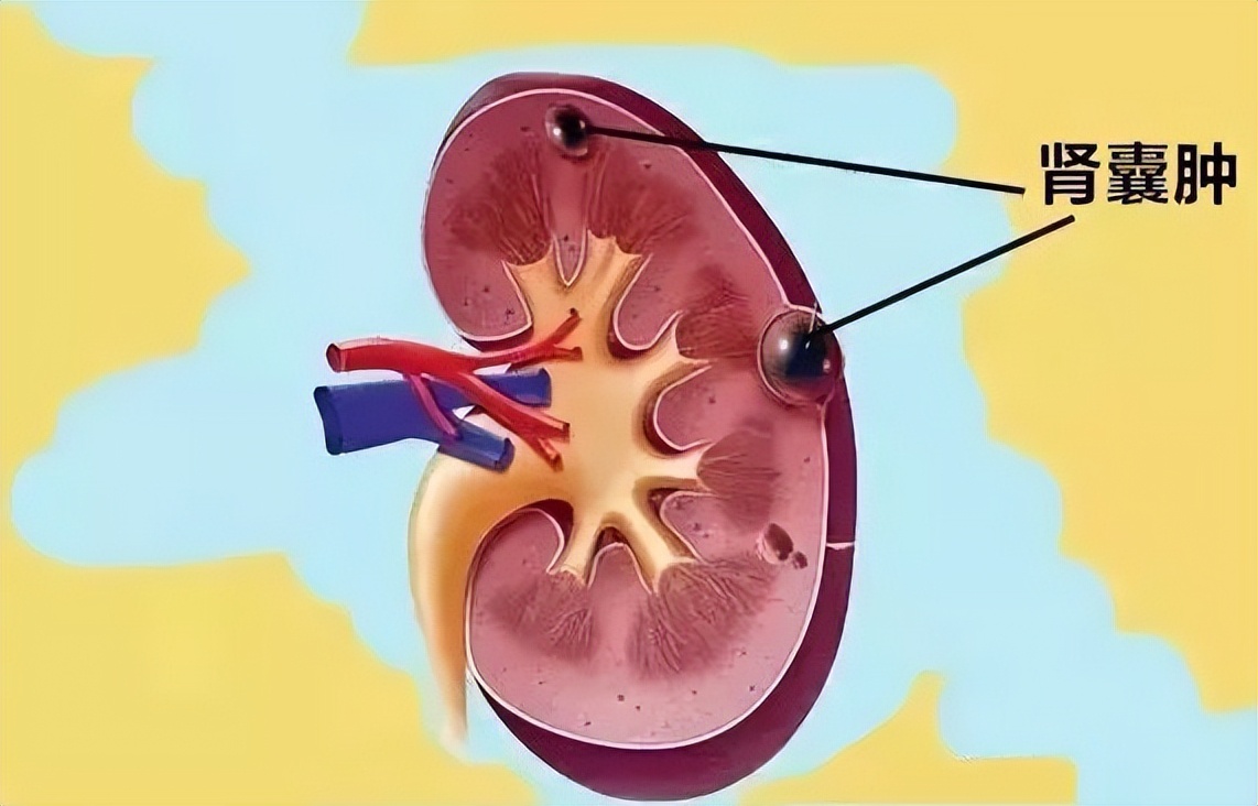 得了肾囊肿该怎么办,查出肾囊肿