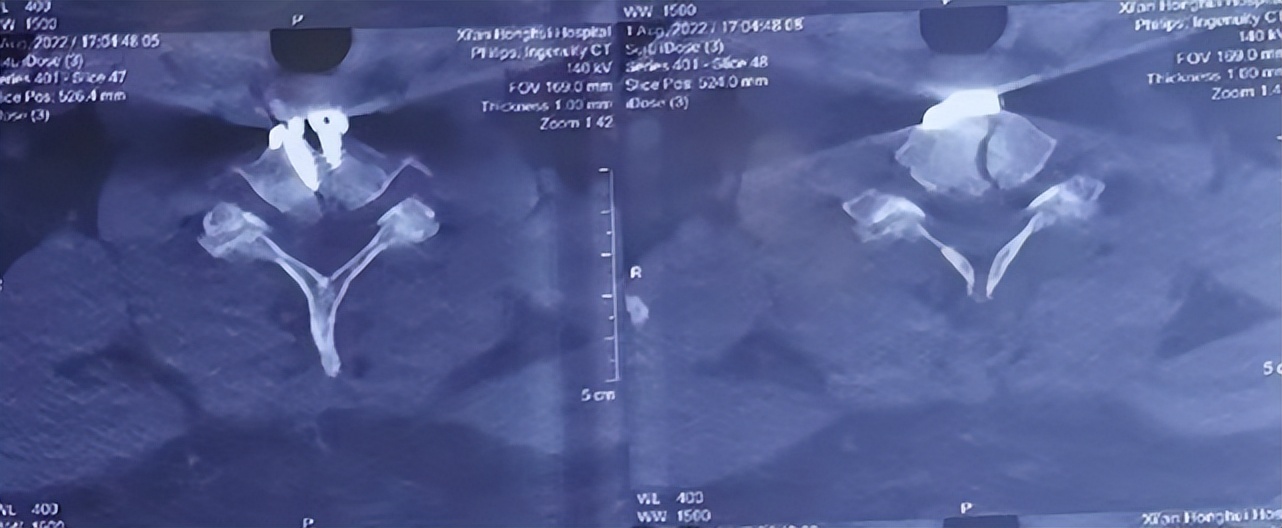 120紧急救援落石砸伤男子,紧急救援男人被电梯压死