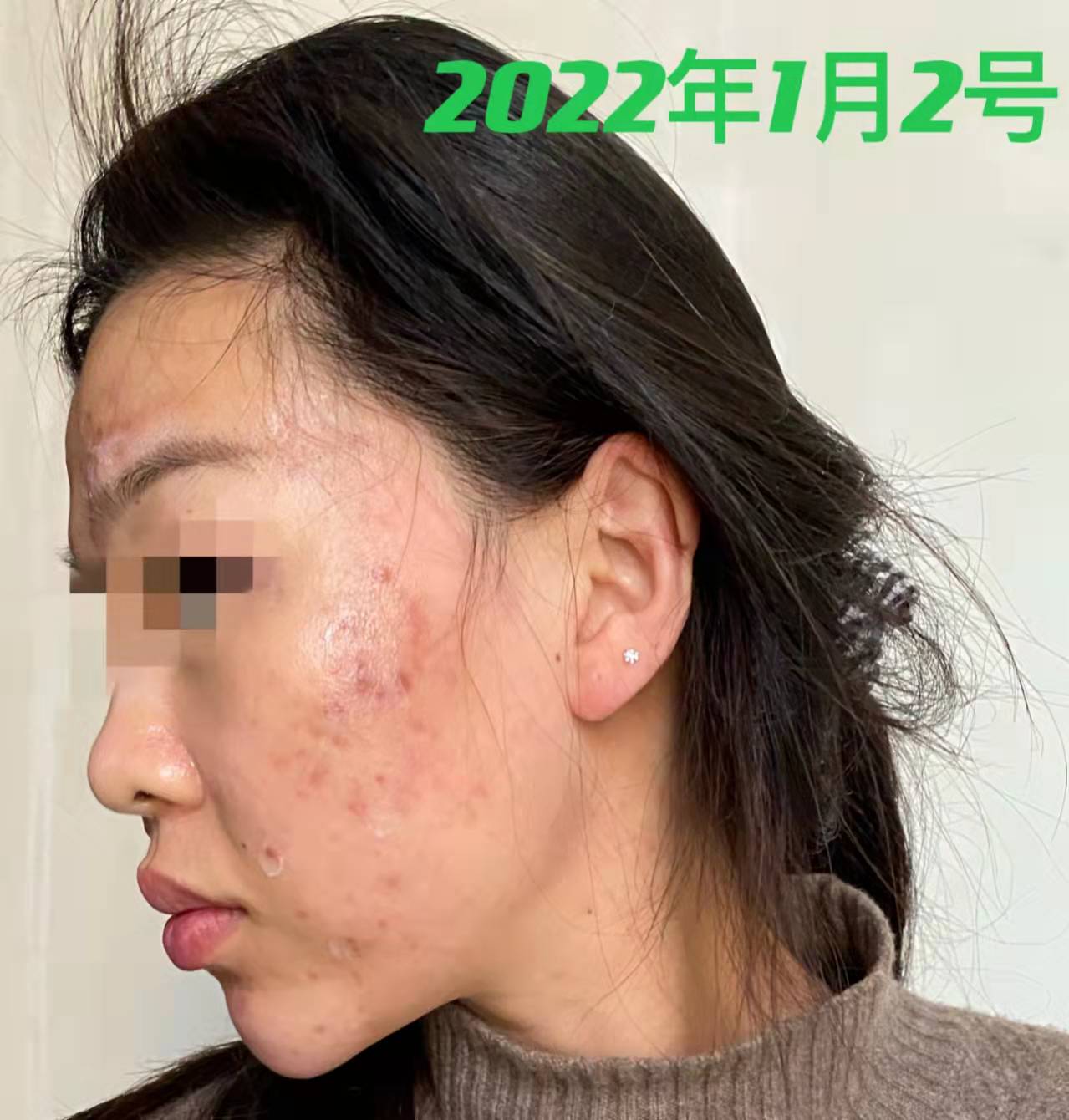 28岁女脸上反复长痘怎么办,28岁痘痘反复长是什么原因