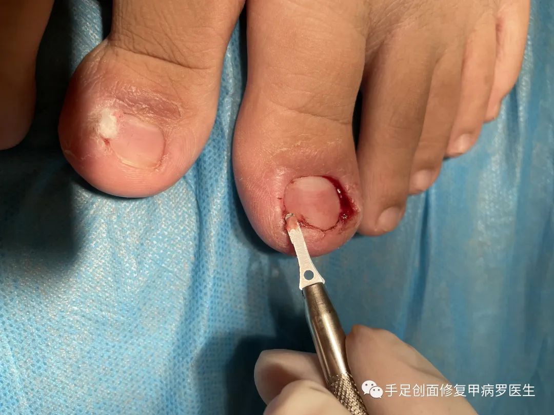 不要等孩子出了问题才重视,孩子得了甲沟炎怎么自己治疗