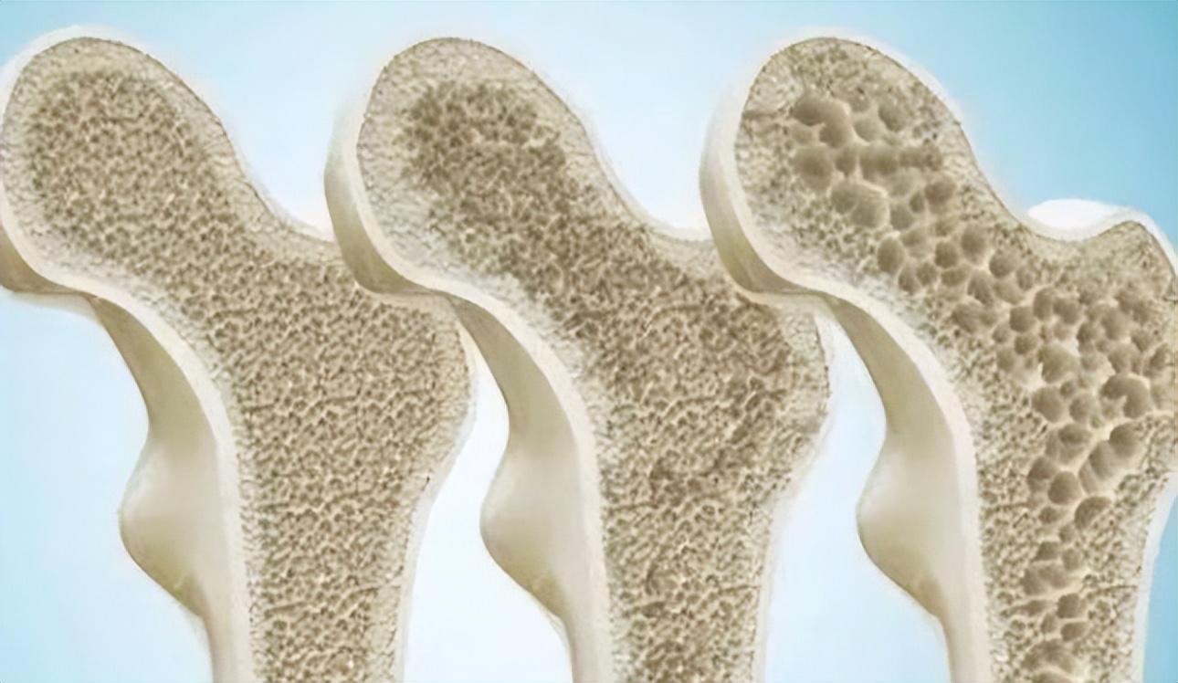 五十多岁骨头一碰就骨折,老人老摔跤是什么病的前兆