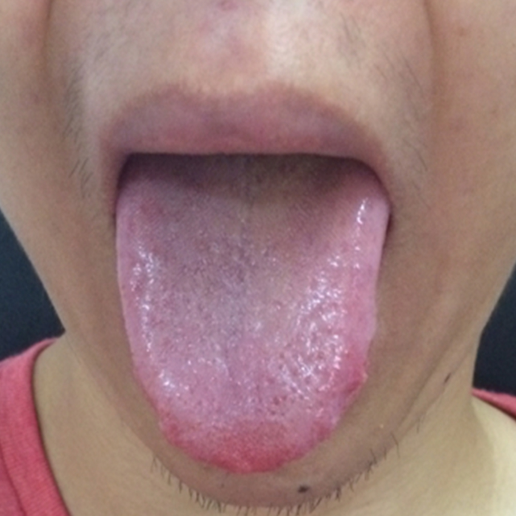 经方治疗慢阻肺呼吸困难黄痰,偶尔咳嗽咳痰呼吸不畅是慢阻肺