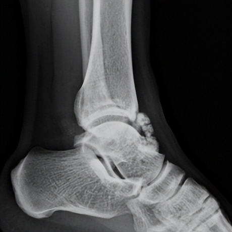 脚踝扭伤的处理方法和注意事项,轻度脚踝扭伤的处理方法及康复