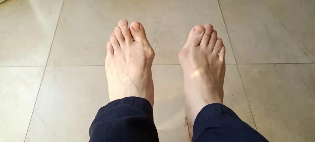 拇外翻疼痛贴什么膏药,拇外翻疼痛抹什么药膏