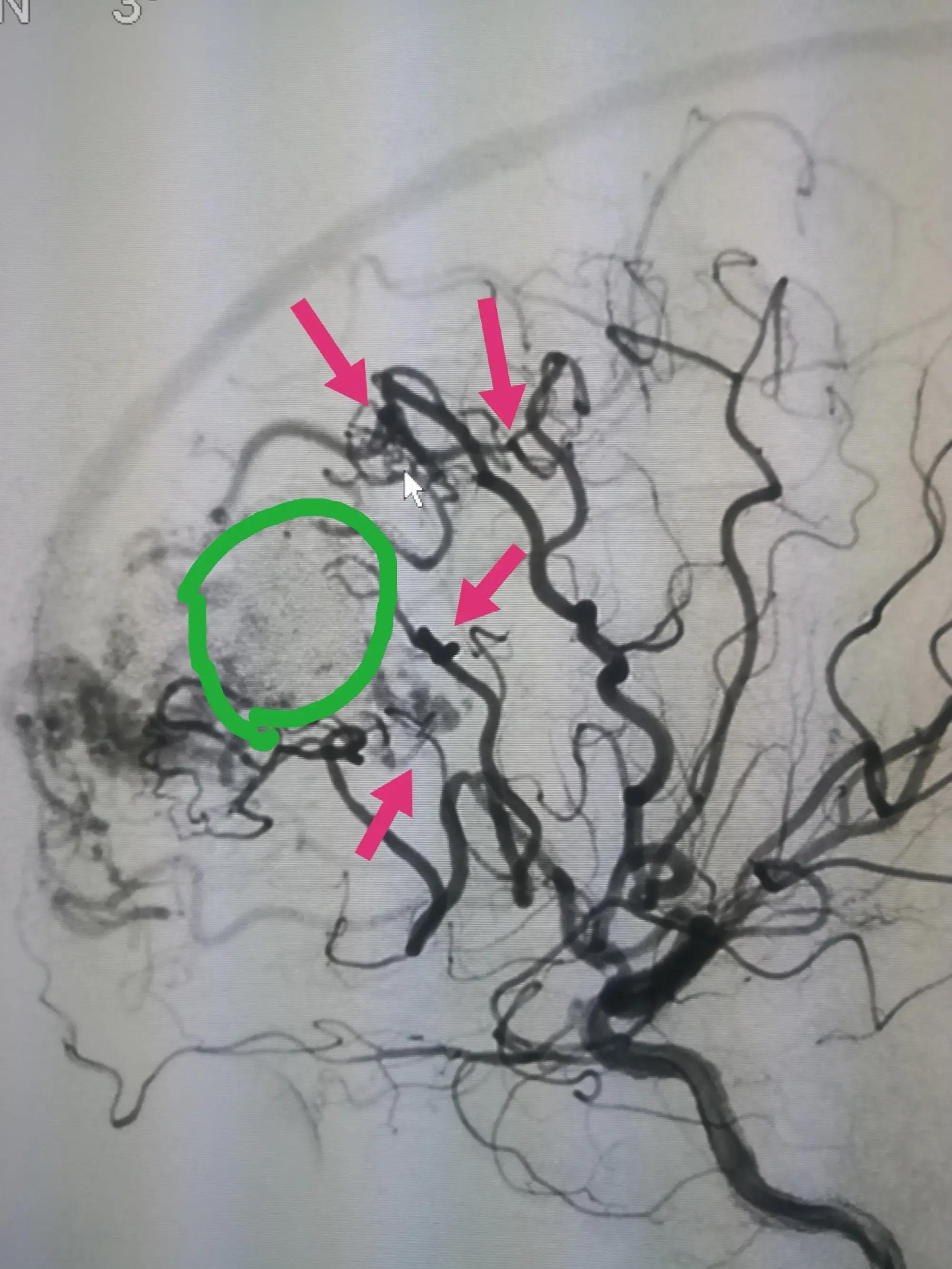 不明原因的眼皮耷拉下垂,可能是这个可怕的病