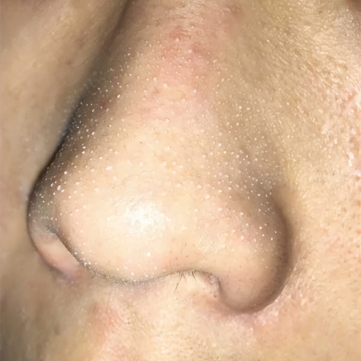 超微小气泡美容有用吗,美容院小气泡