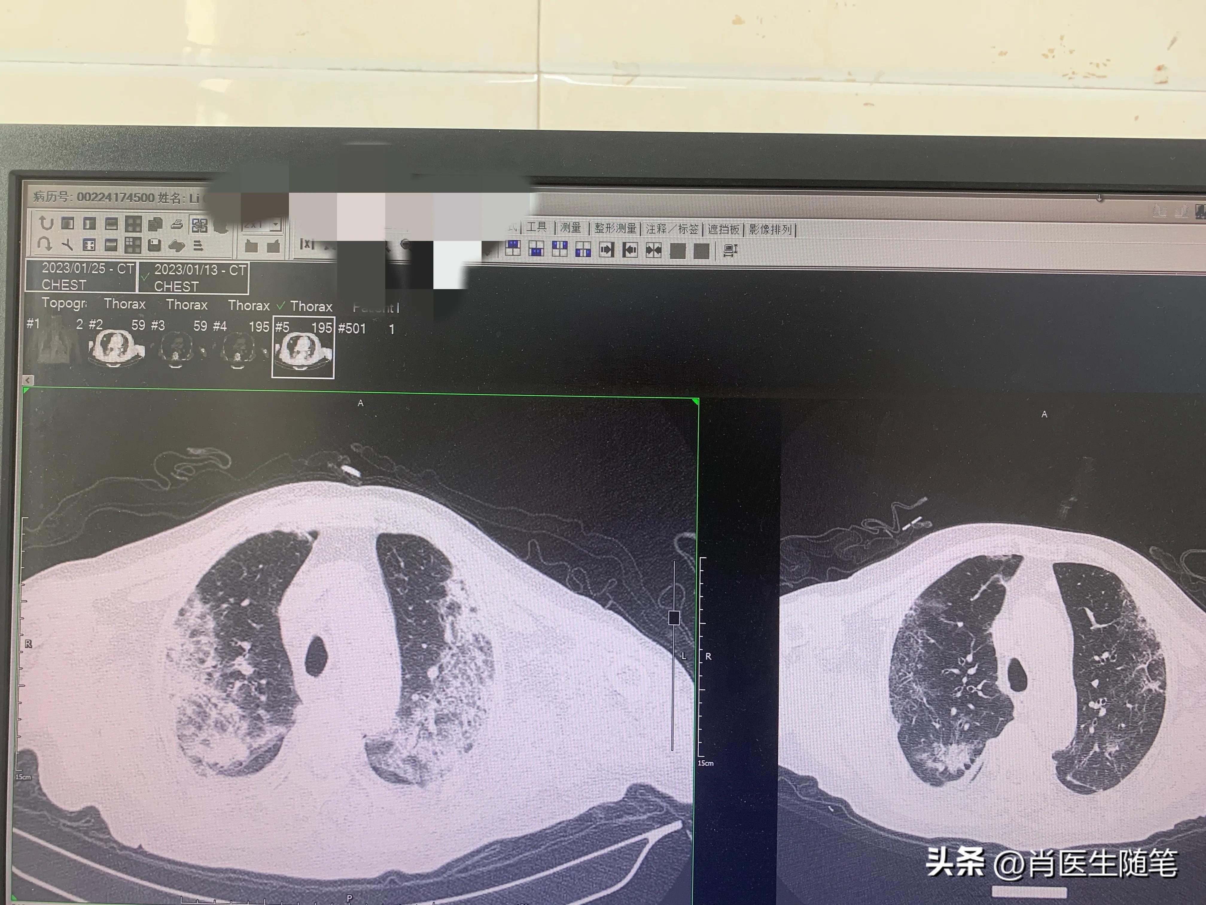 84岁老人白肺治好了,86岁老人得了大白肺还有救吗