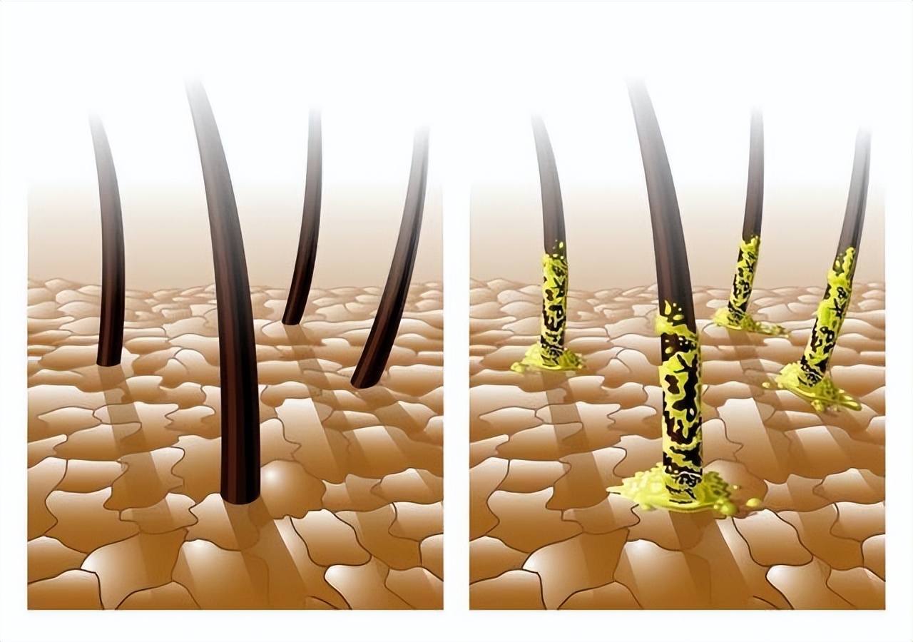 女性身上毛发旺盛什么原因呢,女性身上毛发旺盛什么原因