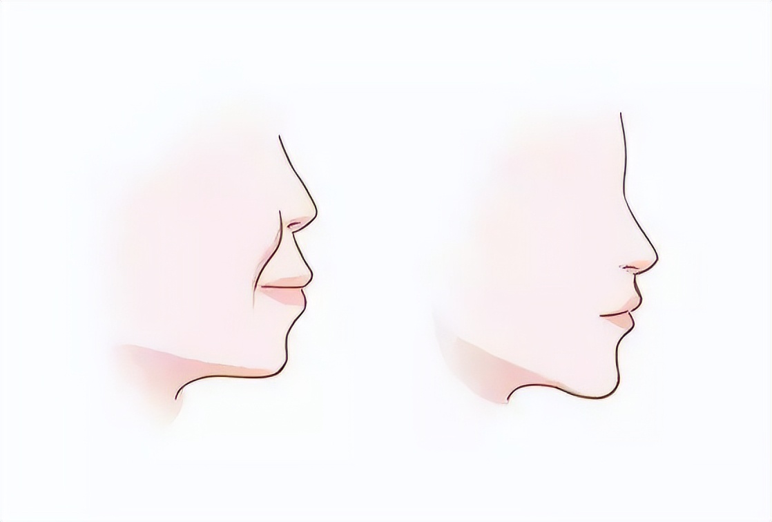 成人深覆合有必要矫正吗,深覆合矫正到一半后悔了