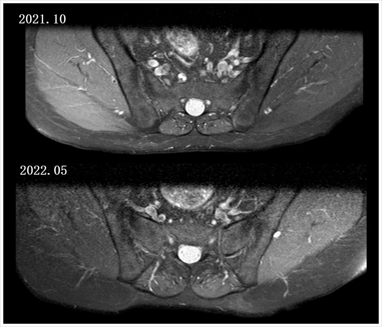 哪些明星患有强直性脊柱炎,明星强直性脊柱炎什么症状