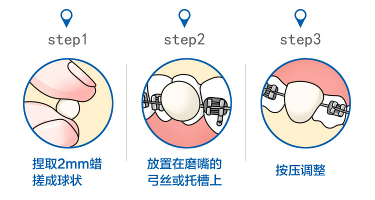 疫情期间牙矫正怎么办,疫情期间牙套复诊不了