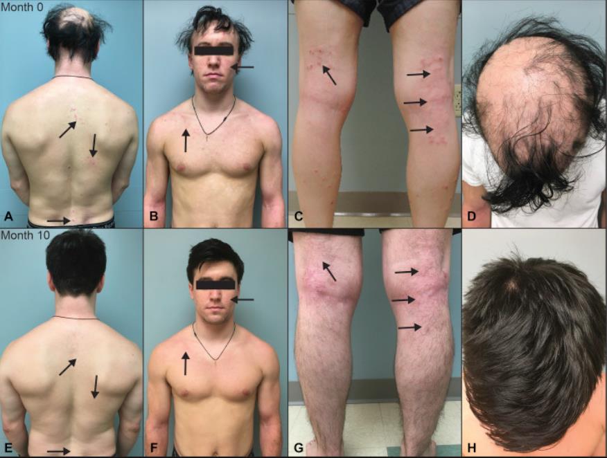 美国男子脱毛,美国男子患罕见疾病天生无锁骨