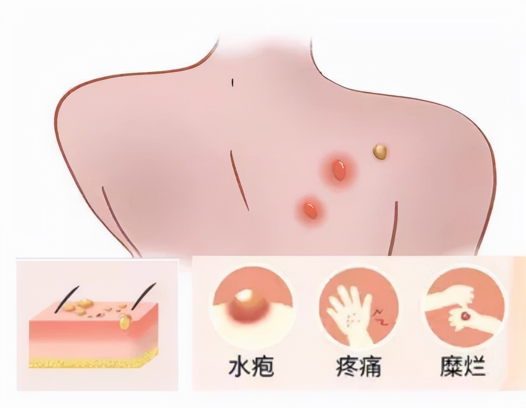 放疗后皮肤刺痛痒怎么办,放疗后皮肤又痒又痛怎么办
