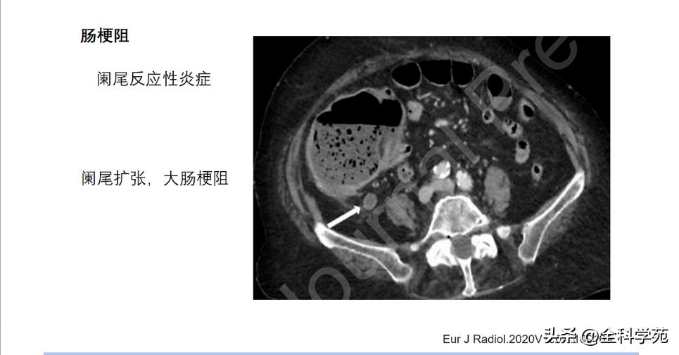 阑尾炎的讲解,关于阑尾炎的讨论总结
