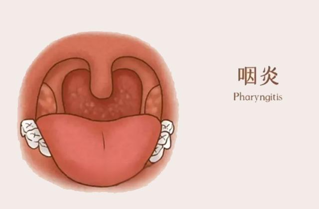 扁桃体炎要连续打几天针才能缓解,快速治扁桃体发炎的方法