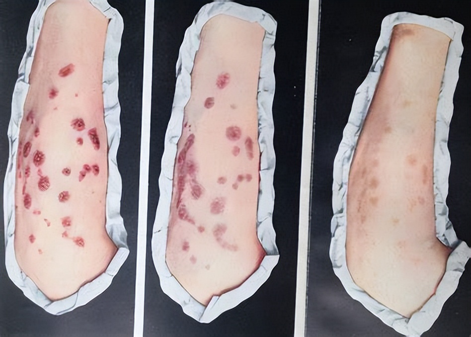 日军给*安妇慰**打的606药剂是什么?痛苦的化疗药物砷凡纳明