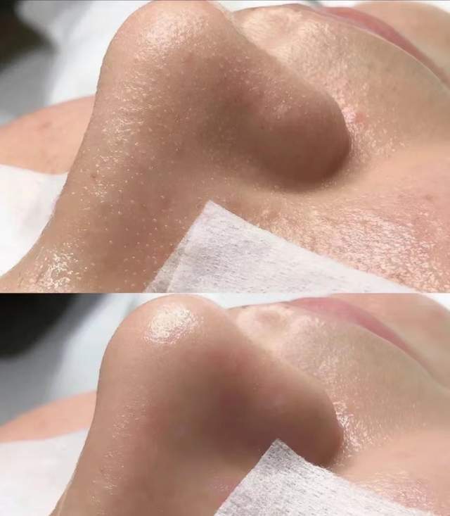 真黑头假黑头傻傻分不清楚，怎么去黑头？