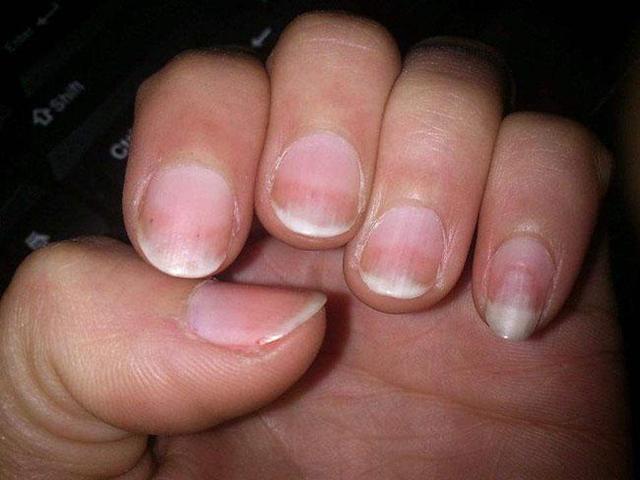 肾衰竭患者为什么表现要经常喝水,为什么肾衰竭人越来越多