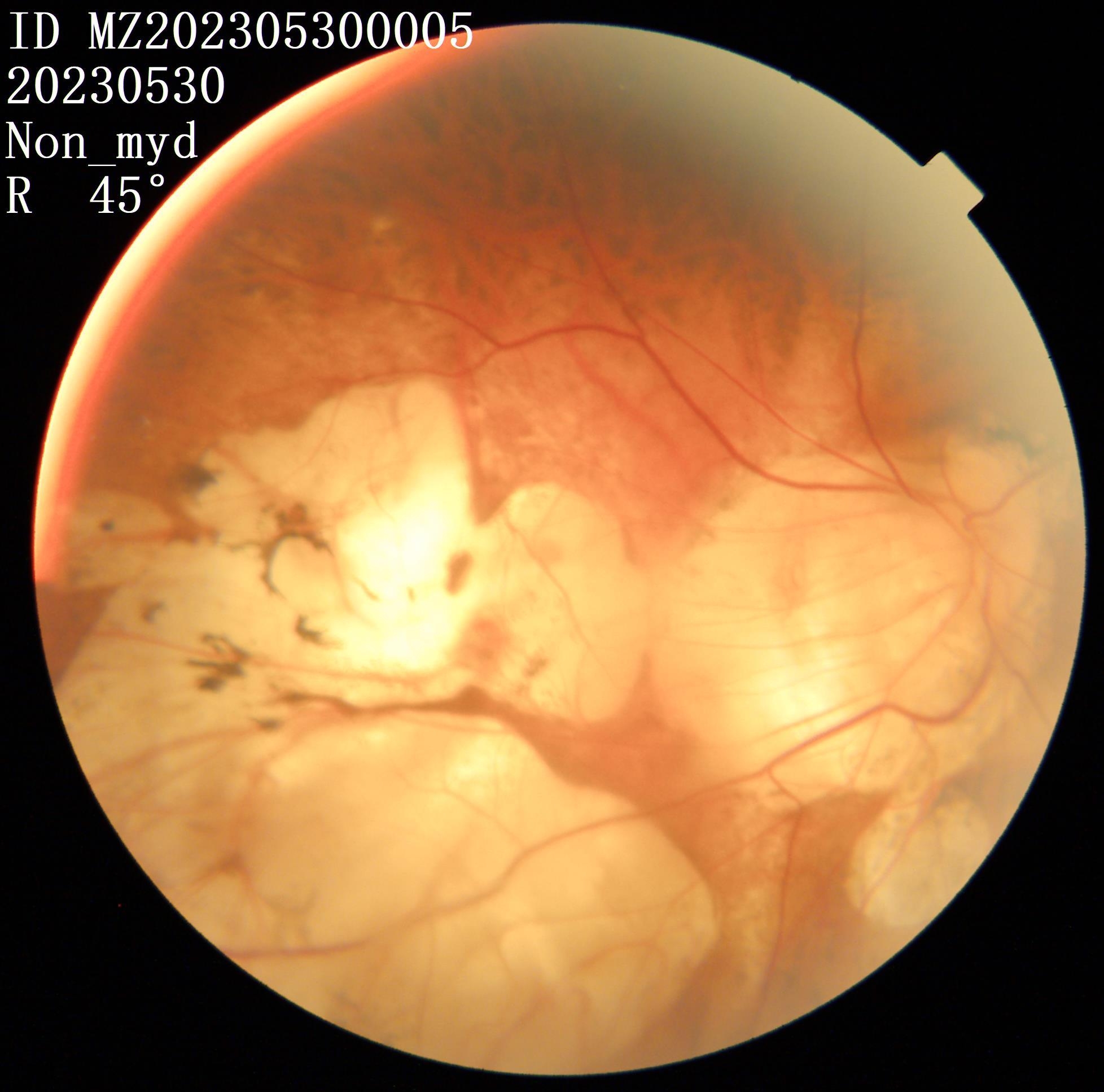 这样“破烂”的超高度近视眼底，还有手术价值吗？