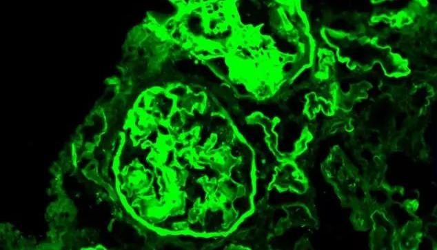 肾功能衰竭全身换血,急性肾衰可以换血么