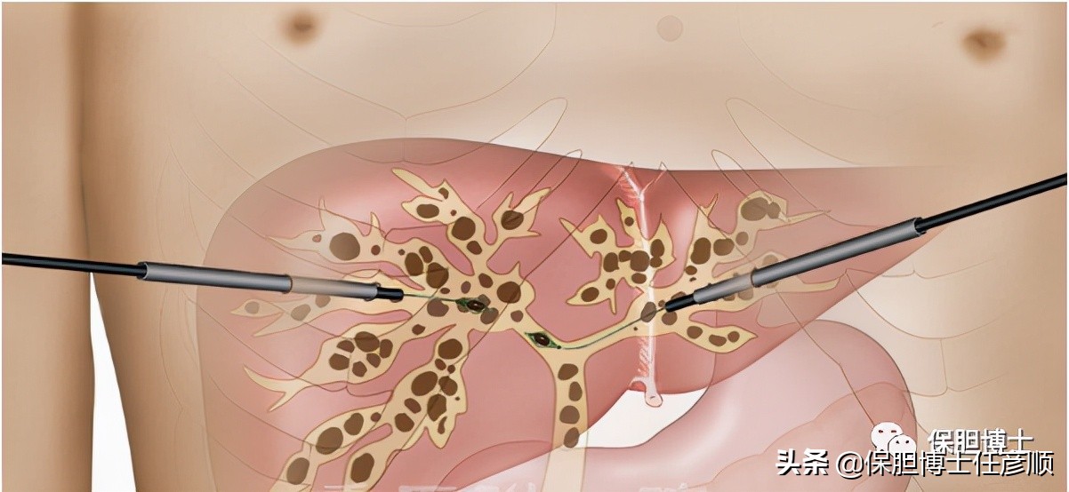 肝内胆管结石能保胆取石吗,肝脏结石能排吗