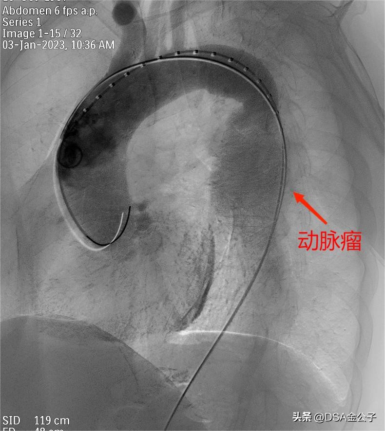 主动脉夹层动脉瘤哪个医院好,主动脉夹层动脉瘤遗传率多高