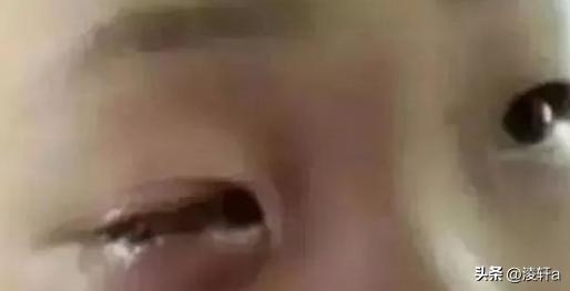 20分钟男童眼球融化,八岁男童眼球瞬间被融化