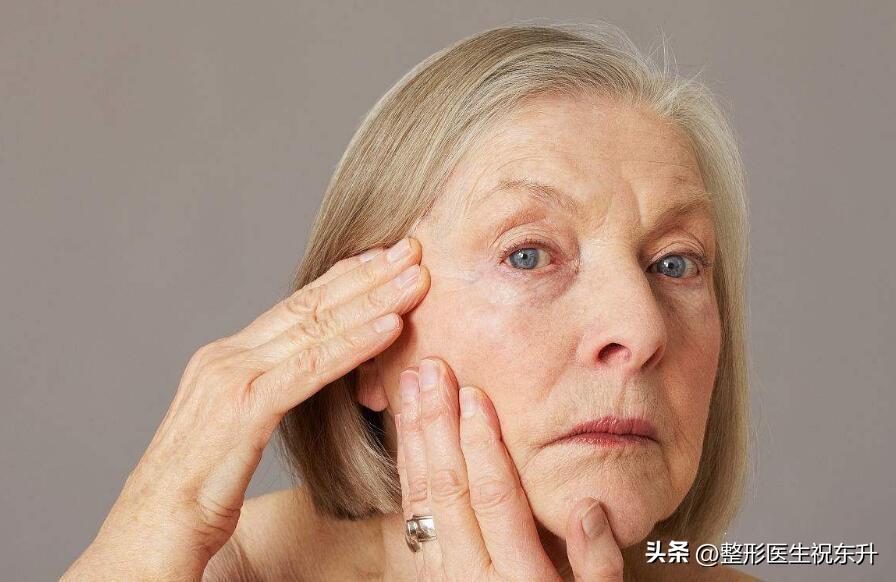 嘴角木偶纹做拉皮手术可以消除吗,做拉皮手术口角纹怎么没去掉