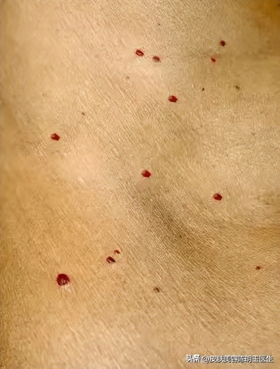 皮肤长红痣是肝有毛病,身上长出红痣是肝脏出了问题吗