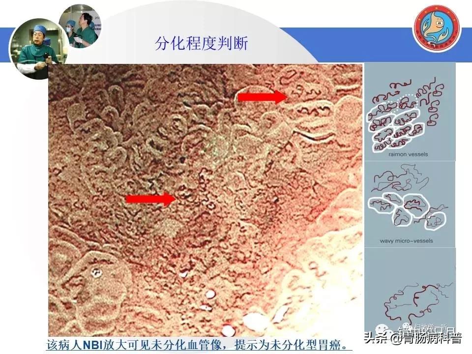 胃癌可以做内镜手术吗,早期胃癌内镜手术后追加外科手术