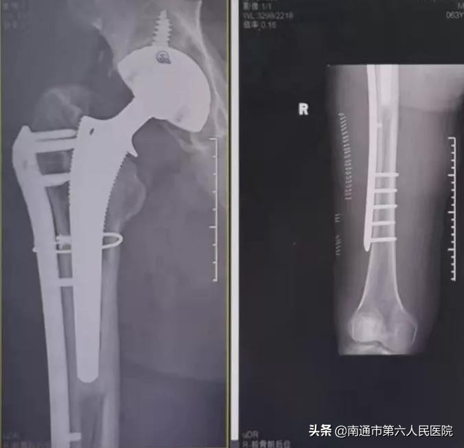 髋关节置换术后骨头疼怎么办,髋关节置换后脚跟骨折怎么康复