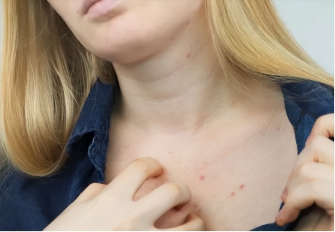 神经性皮炎喝过中药后为啥更痒,手越抓越痒是皮炎还是真菌感染