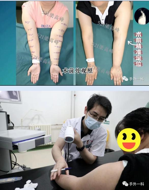 兵器工业521医院常规开展肿瘤术后淋巴水肿治疗手术