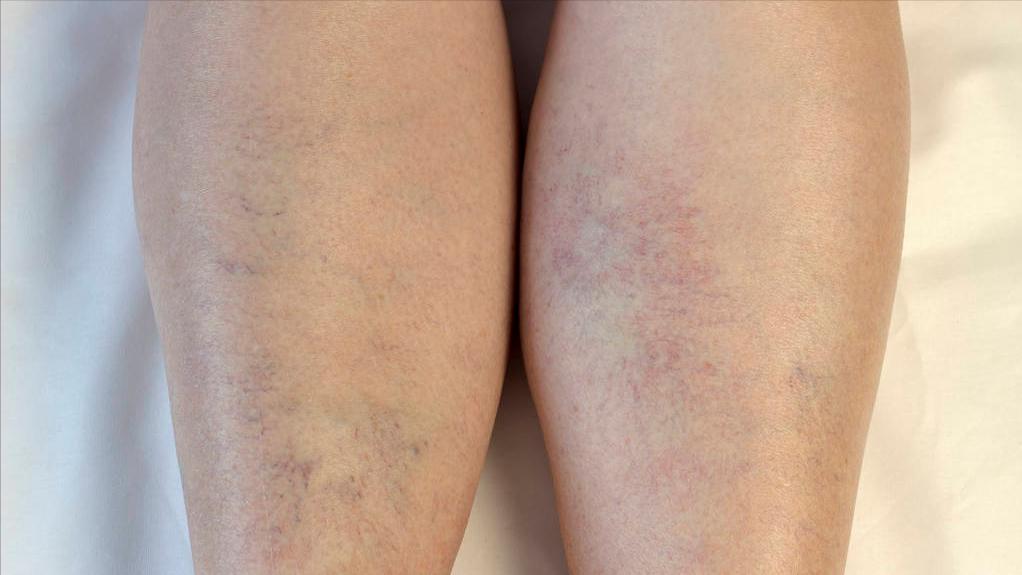 治疗肾病的西药有哪些效果好,肾病前沿治疗又有了新突破