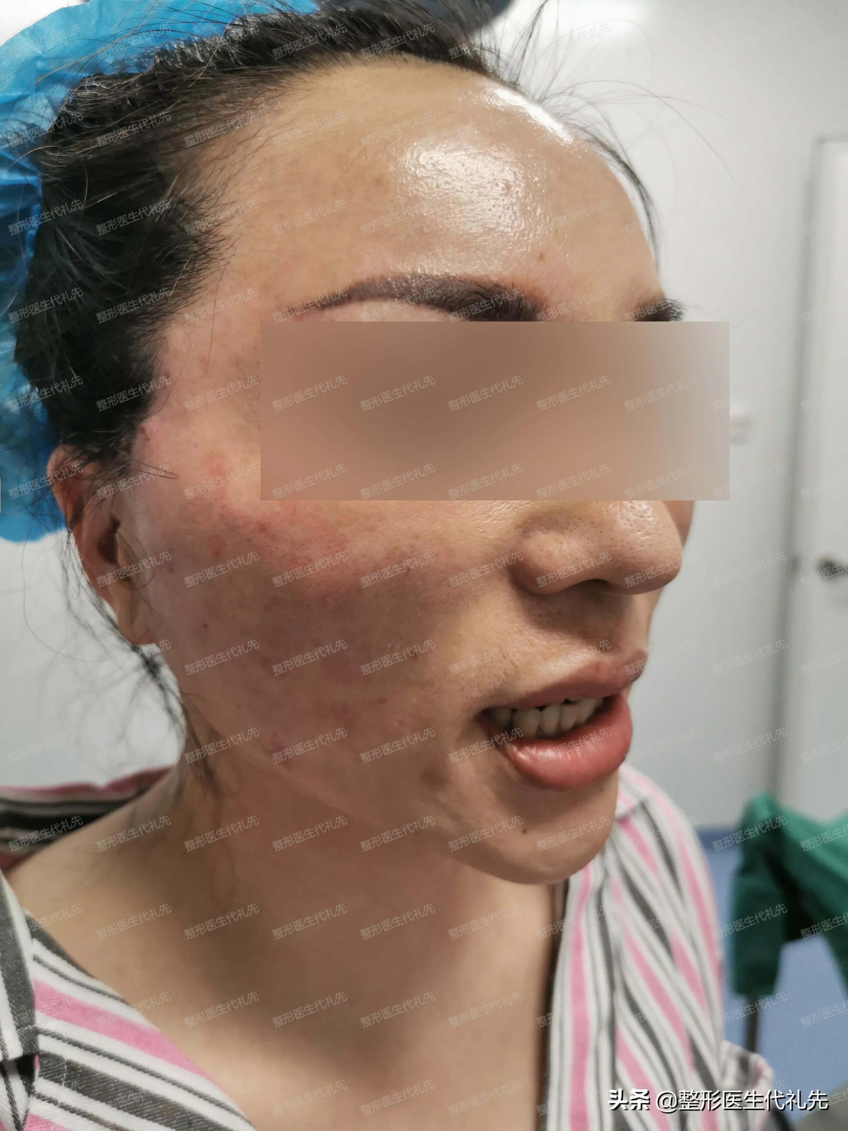 法令纹面部提升手术以后有疤痕吗,法令纹做面部提拉手术有效果吗