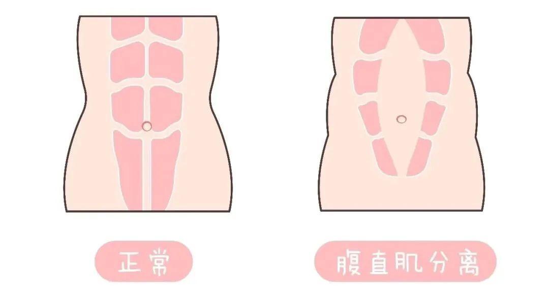 有哪些人建议做产后修复,你们都做产后修复了吗有效果吗