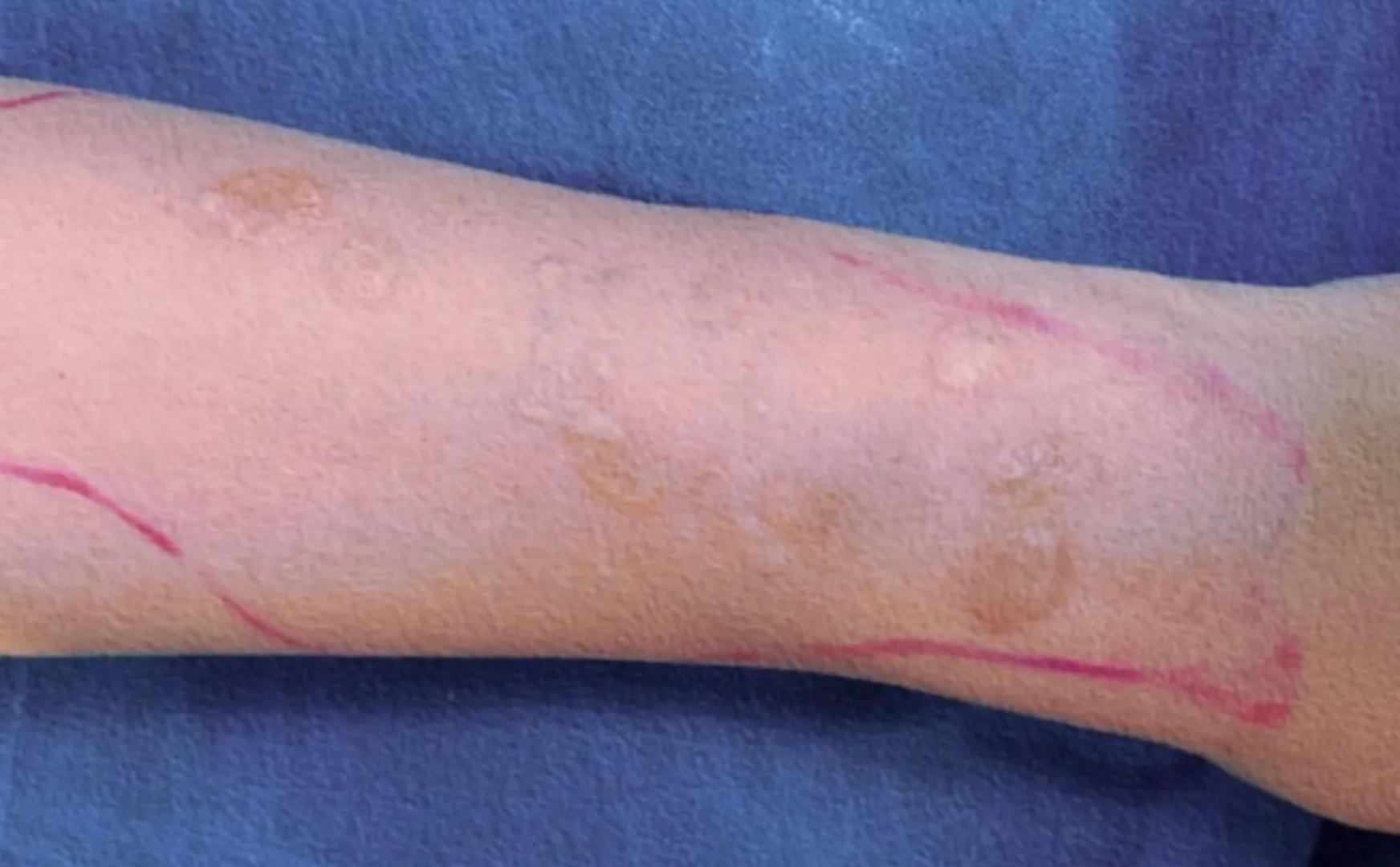 我，28岁，网恋奔现后对方变心，为表真心烫了六个烟疤，后悔