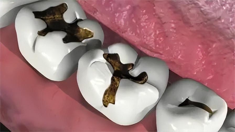 蛀牙不疼有必要医治吗,蛀牙只剩下残根但是不疼要不要拔