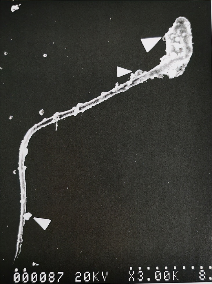 uu感染会自愈么,uu感染是hiv吗