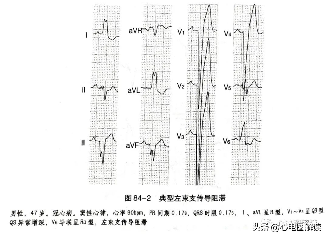 II、III、aVF导联的正常q波、异常Q波