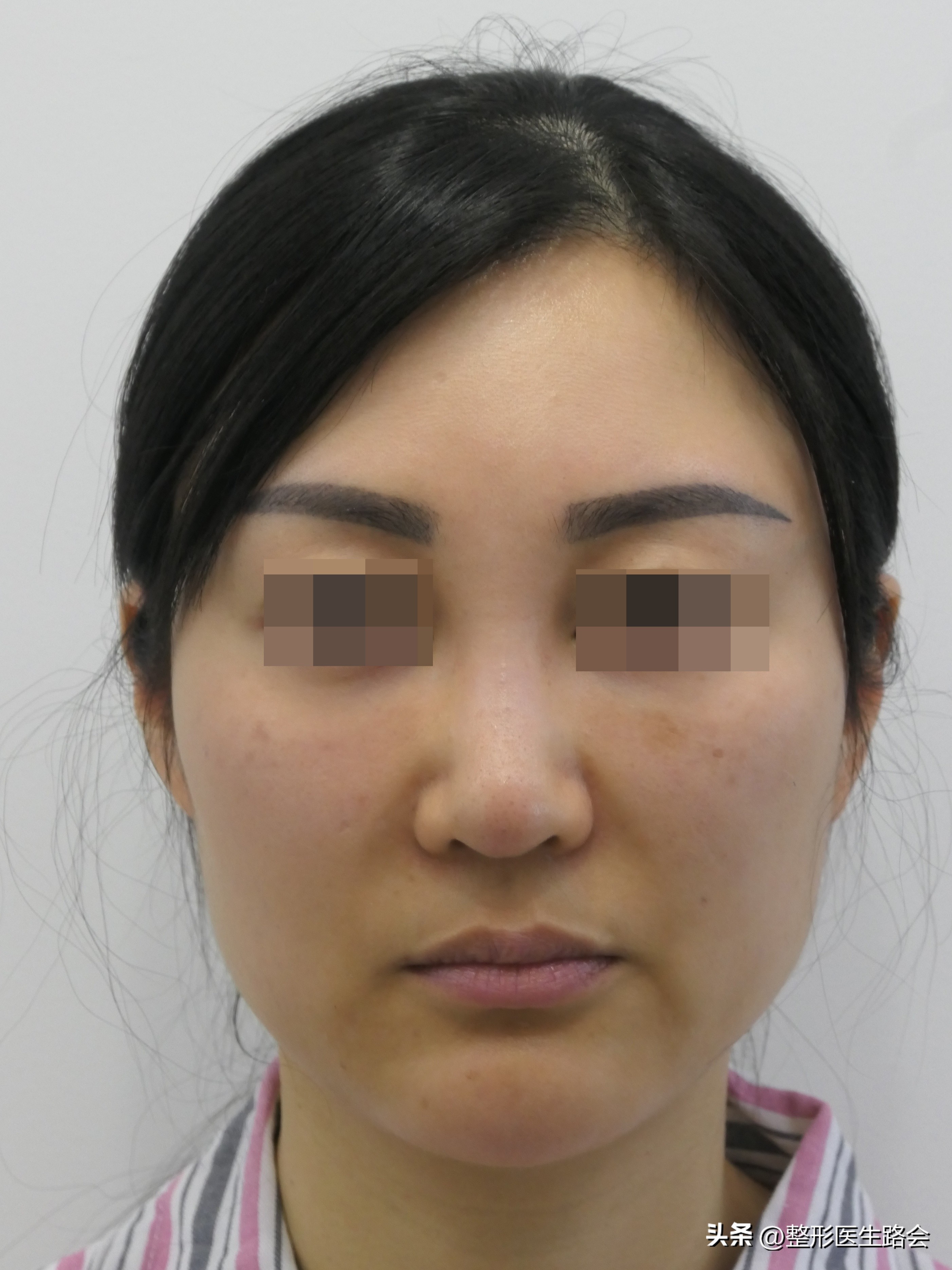 法令纹鼻基底填充靠谱吗,鼻基底填充可以祛法令纹吗