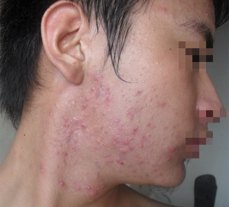 孩子长了青春痘，心里自卑，年纪太小不敢去治疗怎么办？