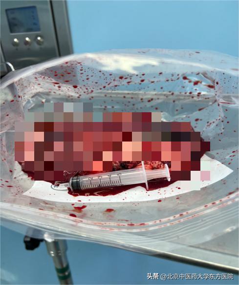 腹腔镜切除卵巢肿瘤,女子肚大似怀孕医生成功摘肿瘤