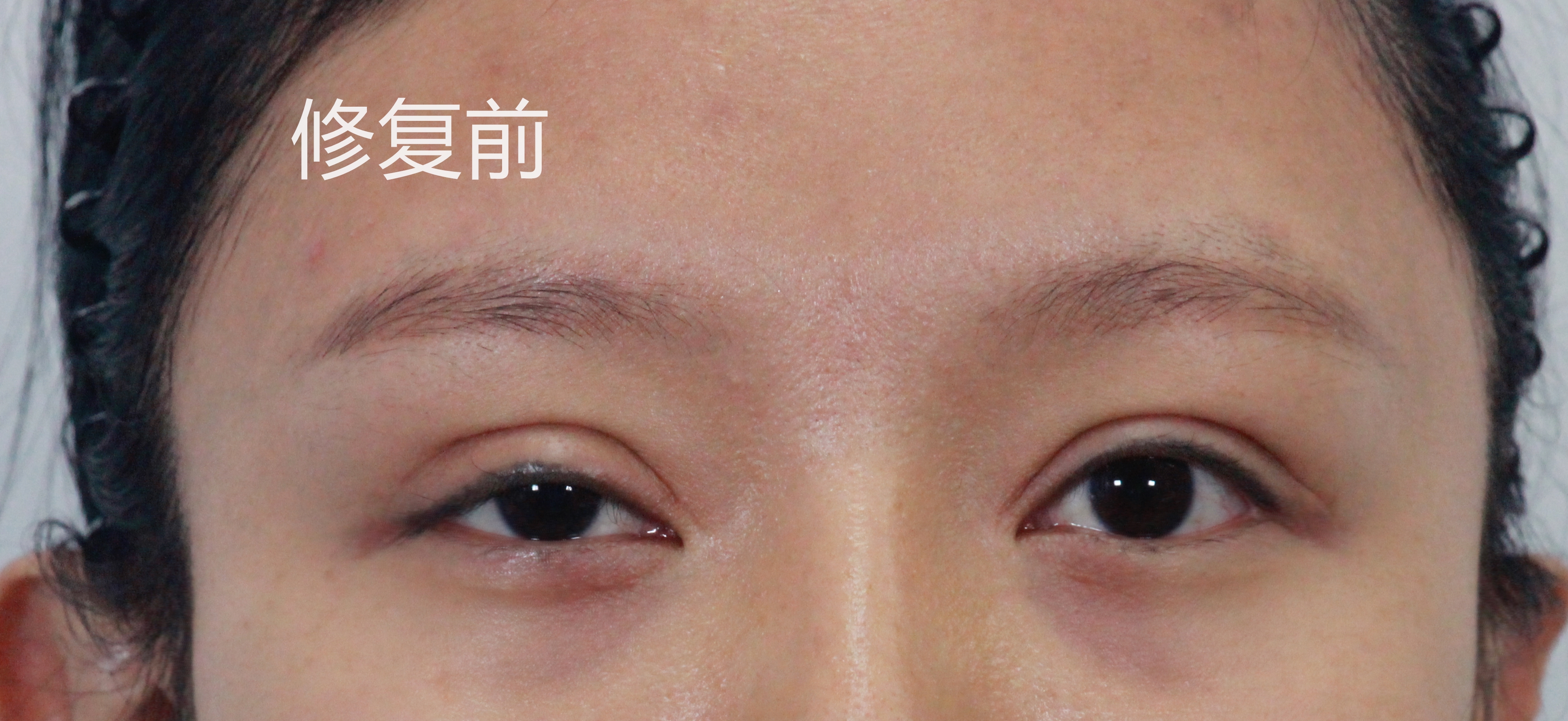 双眼皮修复新乡,姑娘眼部整形后双眼皮变三眼皮