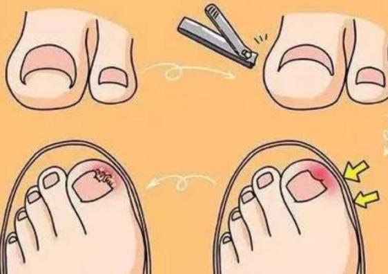 甲沟炎疼痛是指甲在长吗,甲沟炎红肿疼痛怎么快速消肿止疼